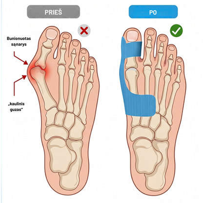 Kineteraapialint hallux valgus korrigeerimiseks ja leevendamiseks