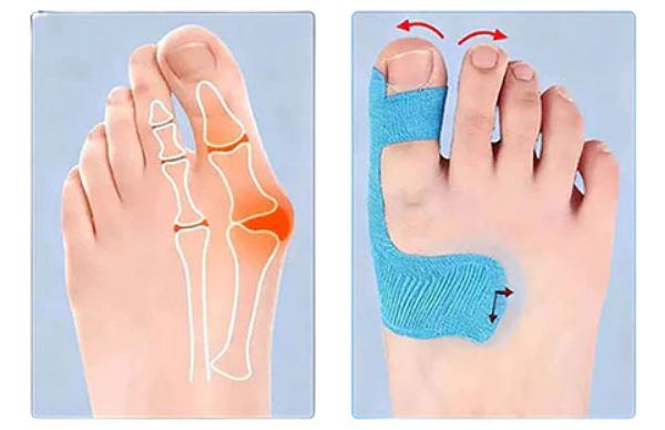 Kineteraapialint hallux valgus korrigeerimiseks ja leevendamiseks